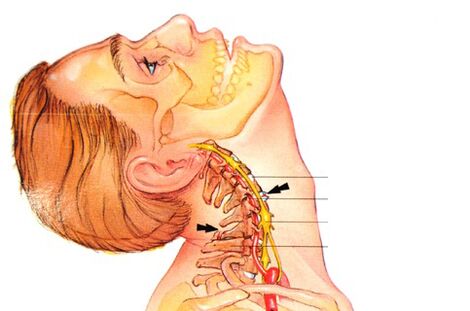 Πώς είναι η οστεοχόνδρωση της αυχενικής μοίρας της σπονδυλικής στήλης; 