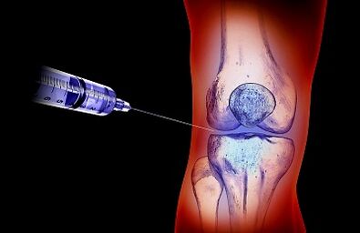 Το σχέδιο θεραπείας για οστεοαρθρίτιδα της άρθρωσης του γόνατος