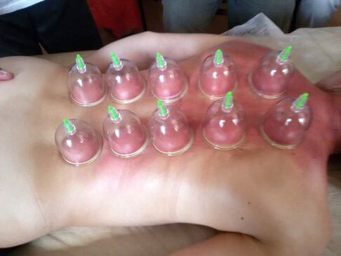 Το vacuum cupping είναι ένας εξαιρετικός τρόπος για τη θεραπεία του πόνου στην πλάτη στο σπίτι